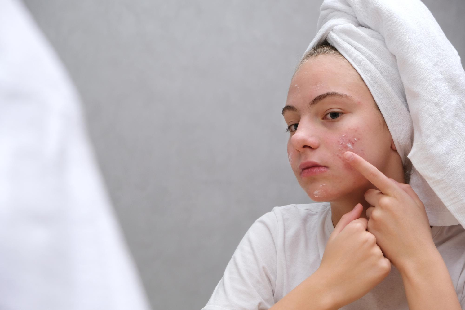 Ako vybrať kozmetiku na akné?
